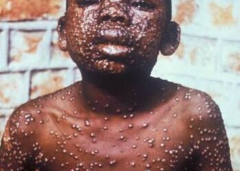 Variole du singe, une nouvelle préoccupation mondiale