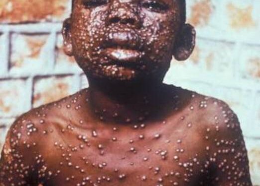 Variole du singe, une nouvelle préoccupation mondiale