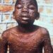 Variole du singe, une nouvelle préoccupation mondiale