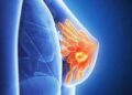 Trois journées de dépistage des cancers du sein et du col utérin