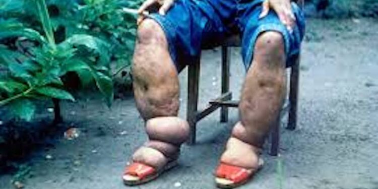 Ce 30 janvier 2025  consacre la Journée mondiale des maladies tropicales négligées