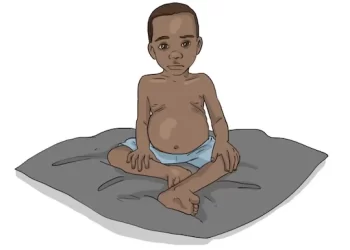 La malnutrition infantile, une urgence humanitaire aux conséquences dévastatrices