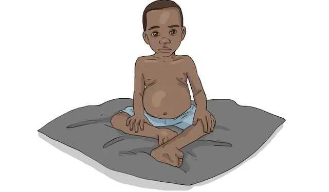 La malnutrition infantile, une urgence humanitaire aux conséquences dévastatrices